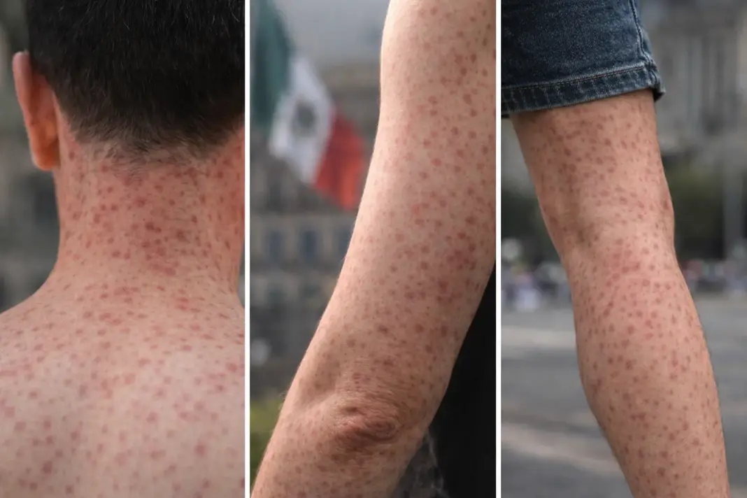 OPS lanza alerta por sarampión en América: casos se disparan y México concentra miles OPS lanza alerta por sarampión en América: casos se disparan y México concentra miles